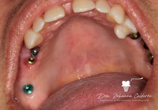 Slider image (3) Dental Implants in Colombia Dr Johanna Calderon